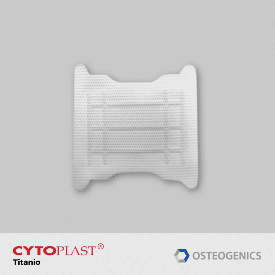 Cytoplast-Ti150-posterior-trans-crestal