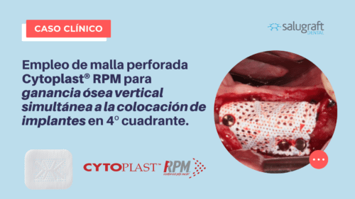 Cytoplast® RPM para ganancia ósea vertical